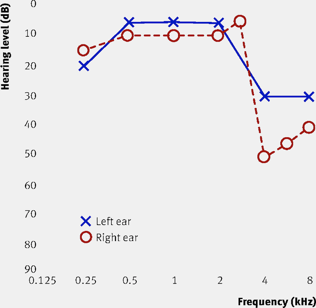 Audiogram of patient showing results from both ears