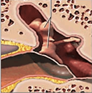 Figure 2. Frontal view of the tympanic membrane showing a more realistic angle of its position in terminating the ear canal.