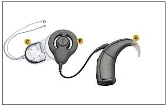Figure 2.  Contemporary cochlear implant components.