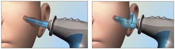 Figure 5. 3D digital ear scanner from Lantos. The left image shows the insertion of the soft conforming membrane into the ear canal. The right image shows the soft conforming membrane expanded with a water based optical dye to the shape of the ear canal. An internal scope advances and retracts to generate a 3D map of the ear canal in real time.