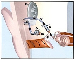 Figure 4.  In this example of a middle ear implant (MEI), a surgical procedure implants an eardrum sensor in the middle ear cavity, takes that signal and amplifies it, sending the amplified signal to the cochlea via exaggerated movement of the auditory ossicles. 