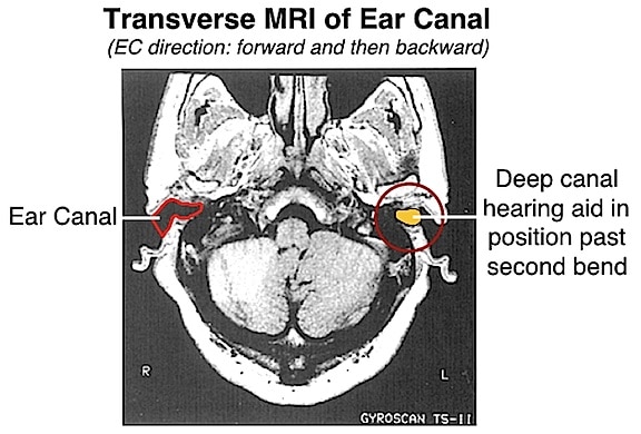 Figure 18.  MRI showing configuration of ear canal (left side), and a deep fitting canal hearing aid inserted beyond the second bend (right side). 