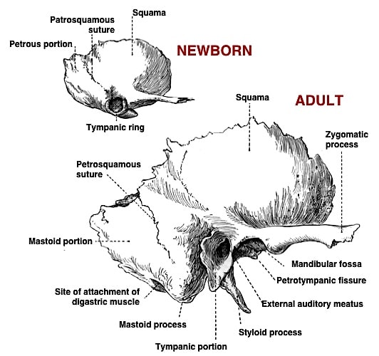  Figure 7.     Temporal bones of newborn and adult, showing differences, with special emphasis on the bony walls of the ear canal opening. In the newborn, the tympanic ring is short and incomplete.     However, in the adult, the posterior-superior portion of the ear canal develops greater bony lining than does the anterior-inferior portion of the ear canal.