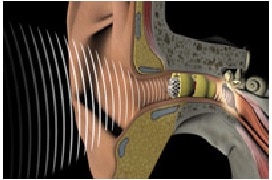 Figure 4. The Lyric semi stock/custom hearing aid designed to fit deeply within the ear canal, close to the tympanic membrane.