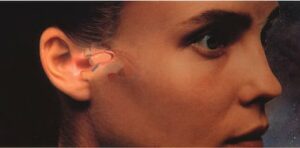 Figure 1. The Philips XP Peritympanic hearing instrument. Its positioning deep within the external auditory canal and in close proximity to the tympanic membrane made it essentially invisible, but even more, offered significant acoustic benefits.