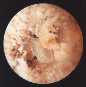 Figure 4. Dry cerumen (earwax), showing its crumbly/flaky, and grayish-white consistency.
