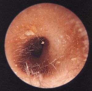Figure 5. Ear hair growing just inside the opening of the ear canal (otoscopic photograph). (Hawke & McCombe, 1955). The light from the light source gives the impression that these are non-pigmented hairs, but they are not.