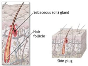 Figure 2. Illustration of a sebaceous (oil) gland as found in the ear canal, showing its location to a hair follicle where it deposits sebum to the hair, allowing it to be brought to the skin surface along the hair shaft to protect the hair and skin from becoming dry, brittle, and cracked. (From Body Guide)