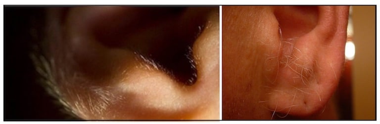 Figure 1. Short vellum hairs (left image) and long vellum hairs (right image) on the tragus, antitragus, and helix. Note the lack of hair pigmentation.