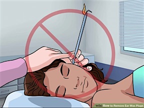 Figure 8. Candling is performed by lighting one end of a hollow candle and placing the other end in the ear canal. The smoke of the candle is said to go down into the ear canal and heat the wax, and then wick it from the canal. This is dangerous and should not be performed. (http://www.wikihow.com/Remove-Ear-Wax-Plugs)