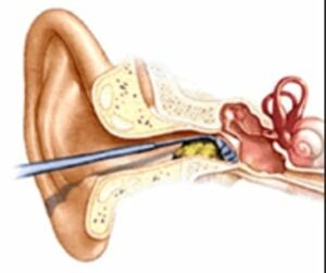 Figure 6. A curette in use. Earwax is loosened and then pulled or scooped from the ear canal (Ear Fix Clinics, UK).