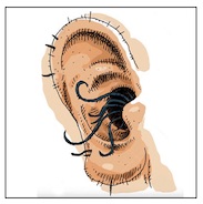 Do You Have Hairy Ears? | Hearing Health & Technology Matters