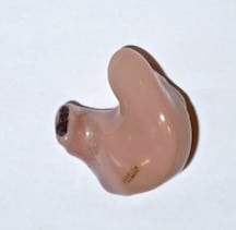 Figure 3. In-the-ear (ITE) hearing aid with sound bore plugged with earwax.