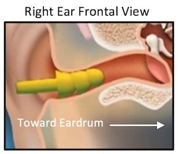 Figure 2. This image is of the right ear as viewed from the front. It shows a flanged earpiece in the ear canal. Most hearing aids do not use a three-flanged tip as shown on this earplug, but use a single or double flange (or what some refer to as a dome or umbrella). Such designs can also push cerumen into the ear canal, but have an added action advantage of “scraping” the ear canal during withdrawal, and thus, pulling ear wax with it. This action is enhanced the more deeply the earpiece is inserted, and especially when past the cerumen-producing area of the ear canal. With consistent use, it is speculated that cerumen would not build up in such a system.