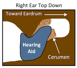 Figure 1. This drawing is of the right ear, looking down on the ear canal. Many hearing aids or earmolds are carrot-shaped (tapered) at the end to facilitate insertion and user comfort. It is possible that they also push ear wax aside during insertion, and because they have little surface friction, do not allow cerumen to adhere during withdrawal. The result could easily be a buildup of cerumen around the tip of the earpiece (light brown colored area). 