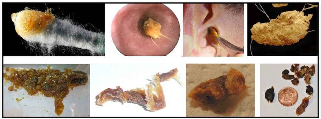 Figure 1. Different forms of impacted cerumen (earwax) that has been removed for the ear (all panels except upper left, which shows wet cerumen taken from the ear canal).
