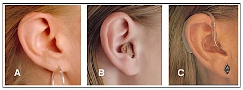 Figure 2. The SeboTek design (A) is shown when compared with an ITE/ITC (B), and a behind-the-ear hearing aid when worn on the ear. Cosmetics have always, and continue to drive hearing aid design and acceptance.