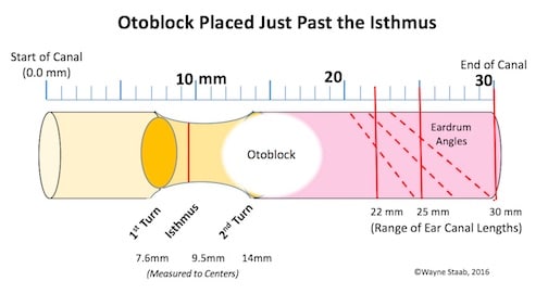 Figure 5. The otoblock most often is compressed when passing through the isthmus between the first and second bends of the ear canal during insertion. When this happens, the otoblock often seems to “disappear” and or “fall” into position as shown here. This provides a false sense of proper placement.