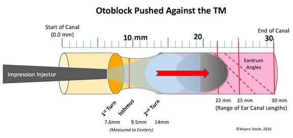 Figure 6. The effect of a poorly-placed otoblock just past the isthmus. Upon injection of ear impression material, the force of the injection can easily push the otoblock against the TM. Of course, this depends on the viscosity of the ear impression material, the type of injector, and the force used to inject the material. Regardless, if the subject’s head moves away from the injection process, you can be assured that the impression material has driven the otoblock against the TM.