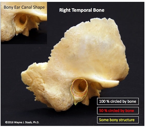 Figure 3. The bony shelf of the temporal bone extends well into, and past the second bend in adult ear canals, possibly into the isthmus area. It is tempting for some to conclude that the cartilaginous canal extends from the aperture of the ear canal to the complete encasement in bone, it is just as logical to contend that the bony portion extends from the tympanic membrane to where there is no bony substructure, meaning possibly to the isthmus.