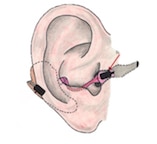 Featured image for “Auriculostomy – First Surgical Hearing Aid Approach”