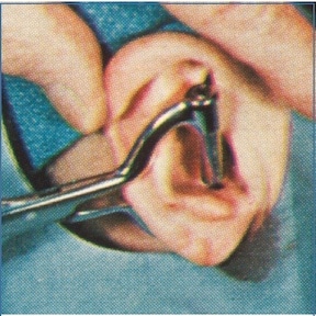 Featured image for “Auriculostomy Hearing Aid – Surgical Procedure”
