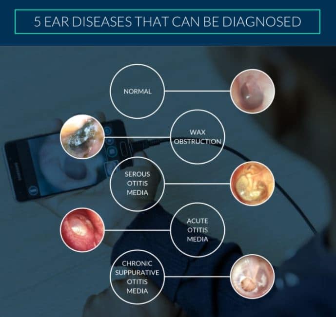 ear disease artificial intelligence