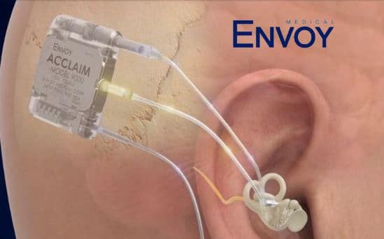 acclaim cochlear implant envoy
