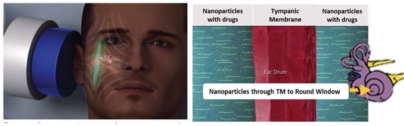 nanoparticles hearing loss treatment