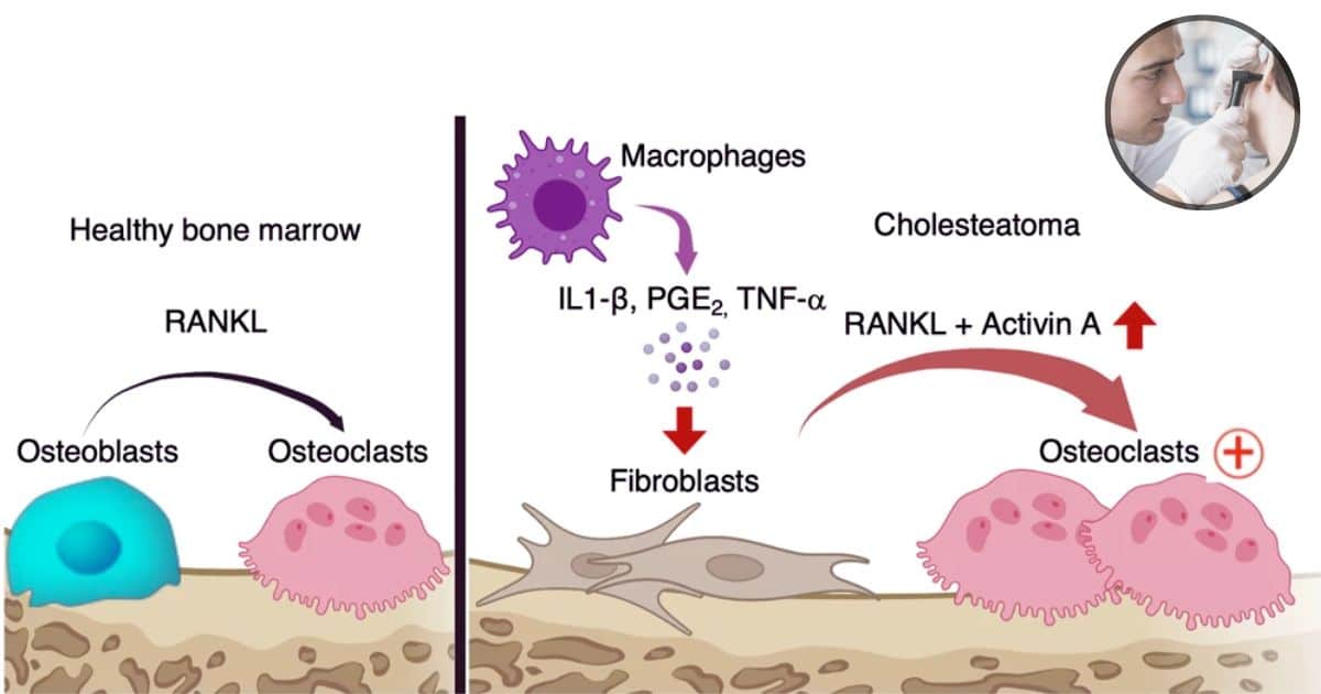 cholesteatoma development