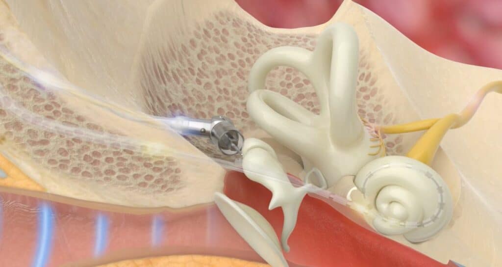 acclaim cochlear implant