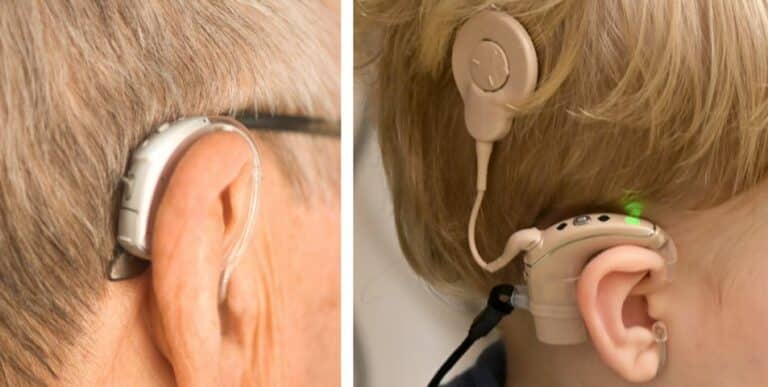 Understanding Cochlear Implants: How Do They Work? Candidacy, Types ...