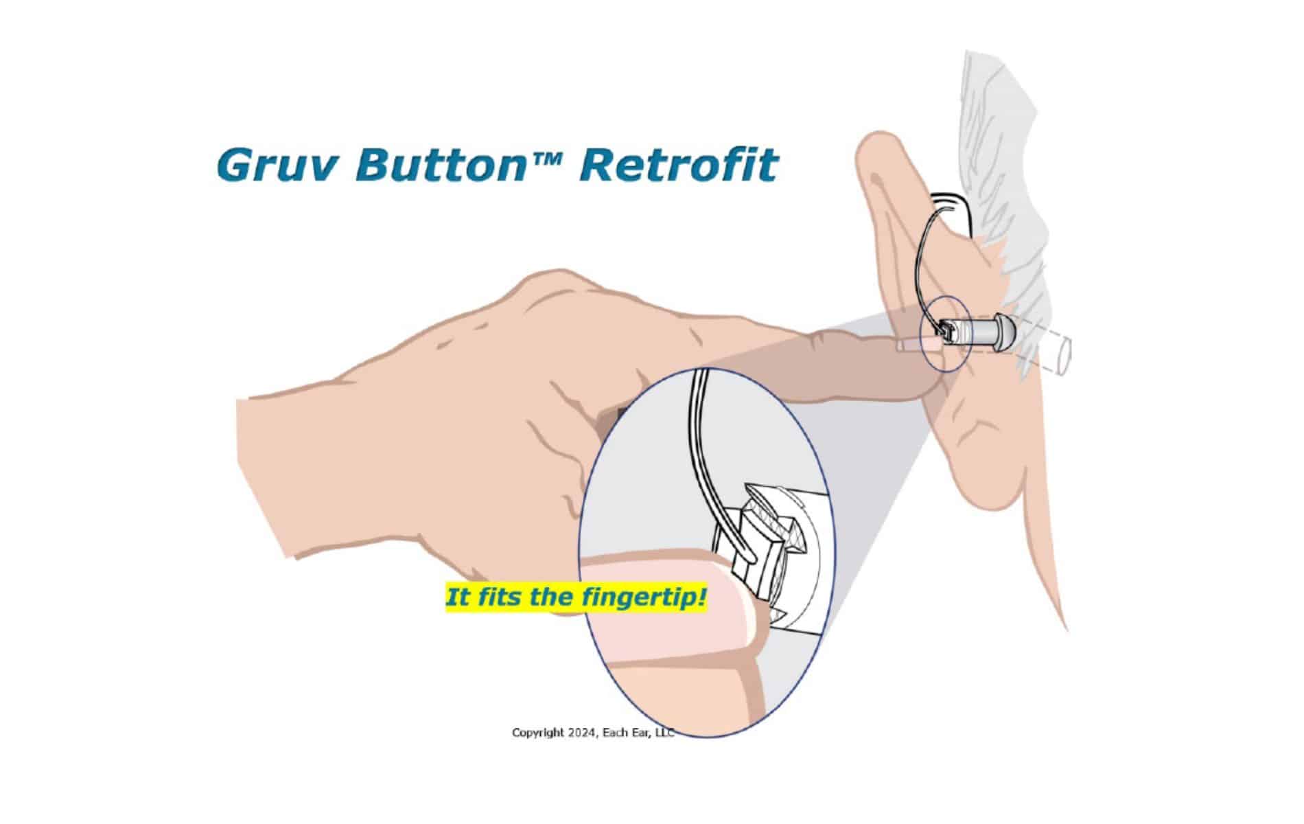 Featured image for “Gruv Button™ Retrofit Makes Hearing Aid Insertion Easy”