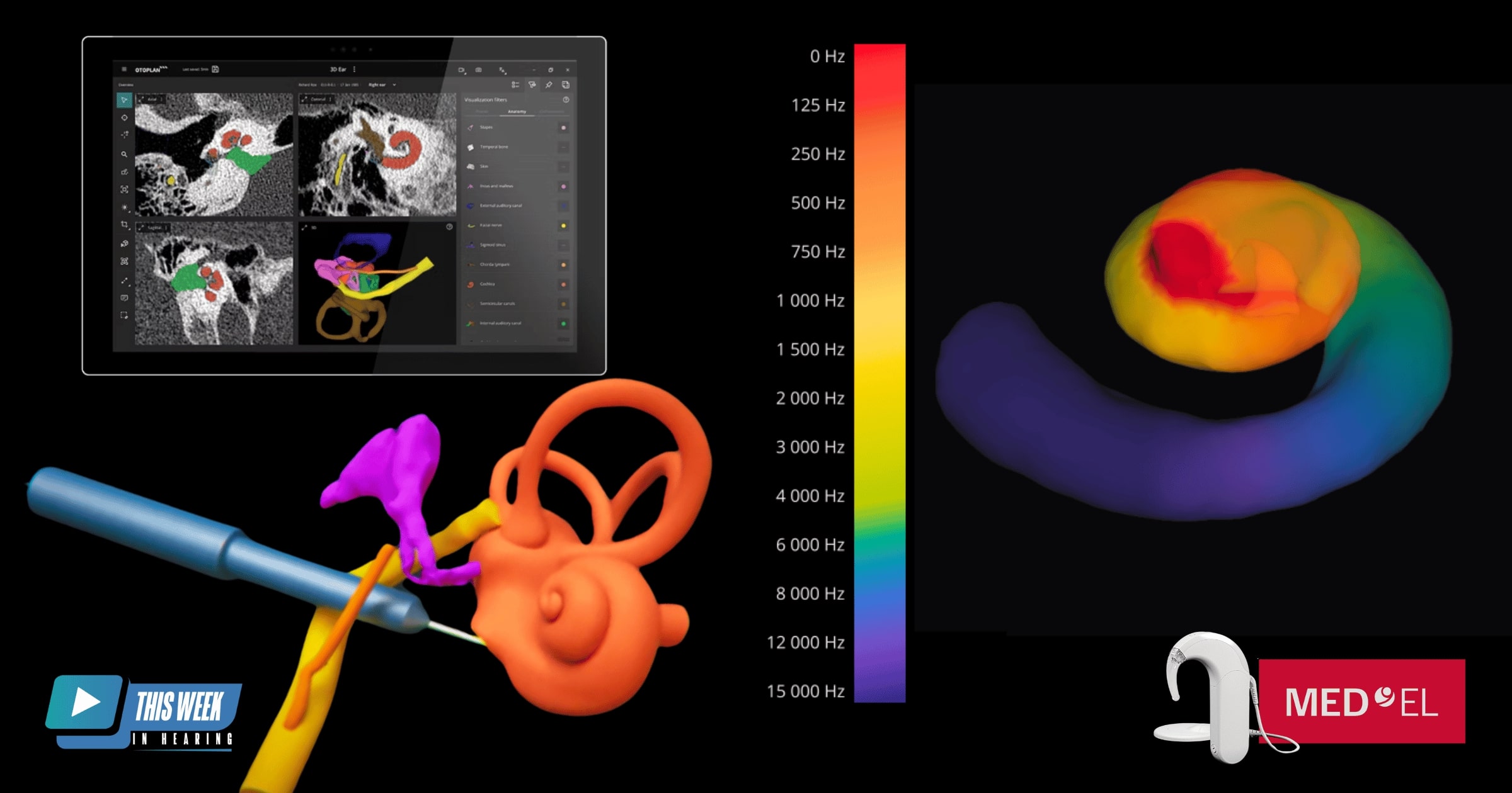 med-el otoplan cochlear implant outcomes