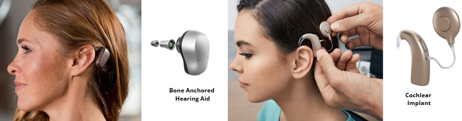 difference between cochlear implant and baha device