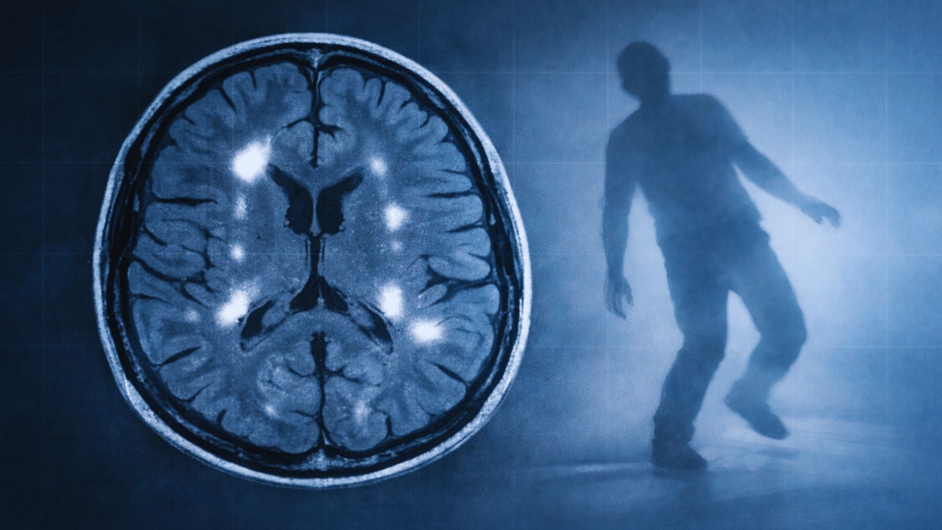 white matter disease dizziness imbalance
