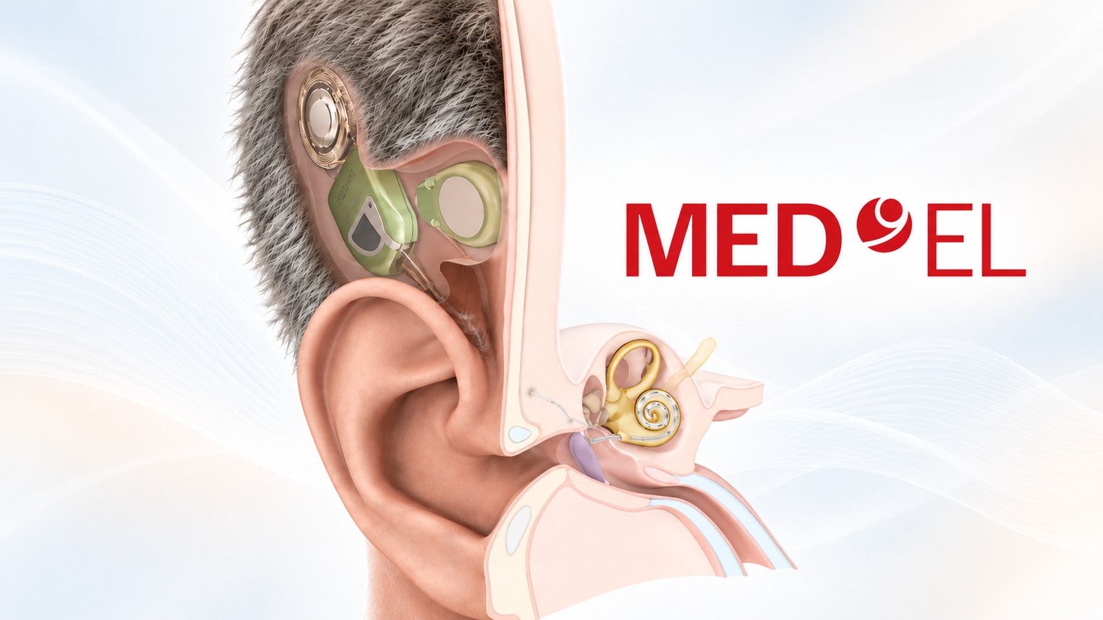 MED-EL Launches TICI UNICO, a Fully Implanted Cochlear Implant With No External Components